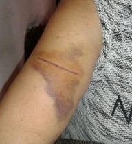 Mujer accidentada por la cuerda de un 'kitesurf' en El Médano