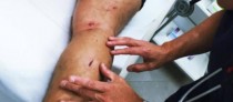 Heridas causadas a un ciudadano por perros en El Médano