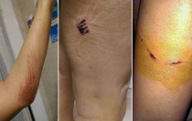 Heridas causadas a una ciudadana por perros en El Médano